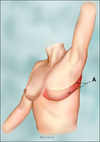 latissimus_dorsi_flap2[2]_tcm8-79052